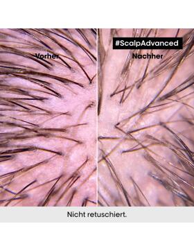 LOr&eacute;al Professionnel Scalp Advanced Anti-Discomfort Intense Soother Treatment 200 ml